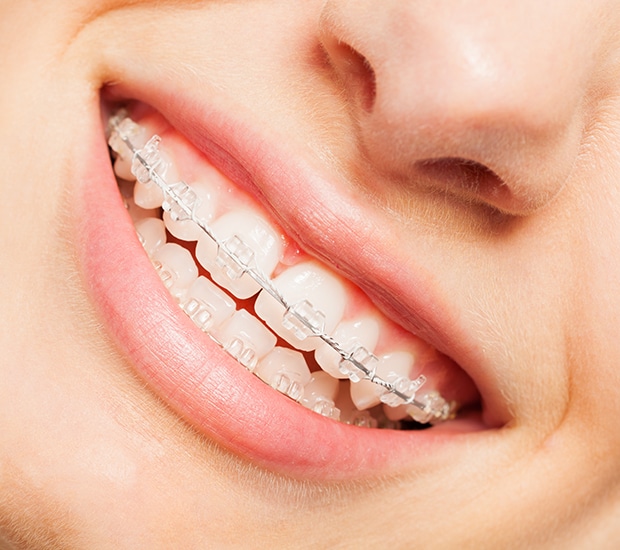 Clear braces at Happier Smiles Orthodontics in Escondido, CA