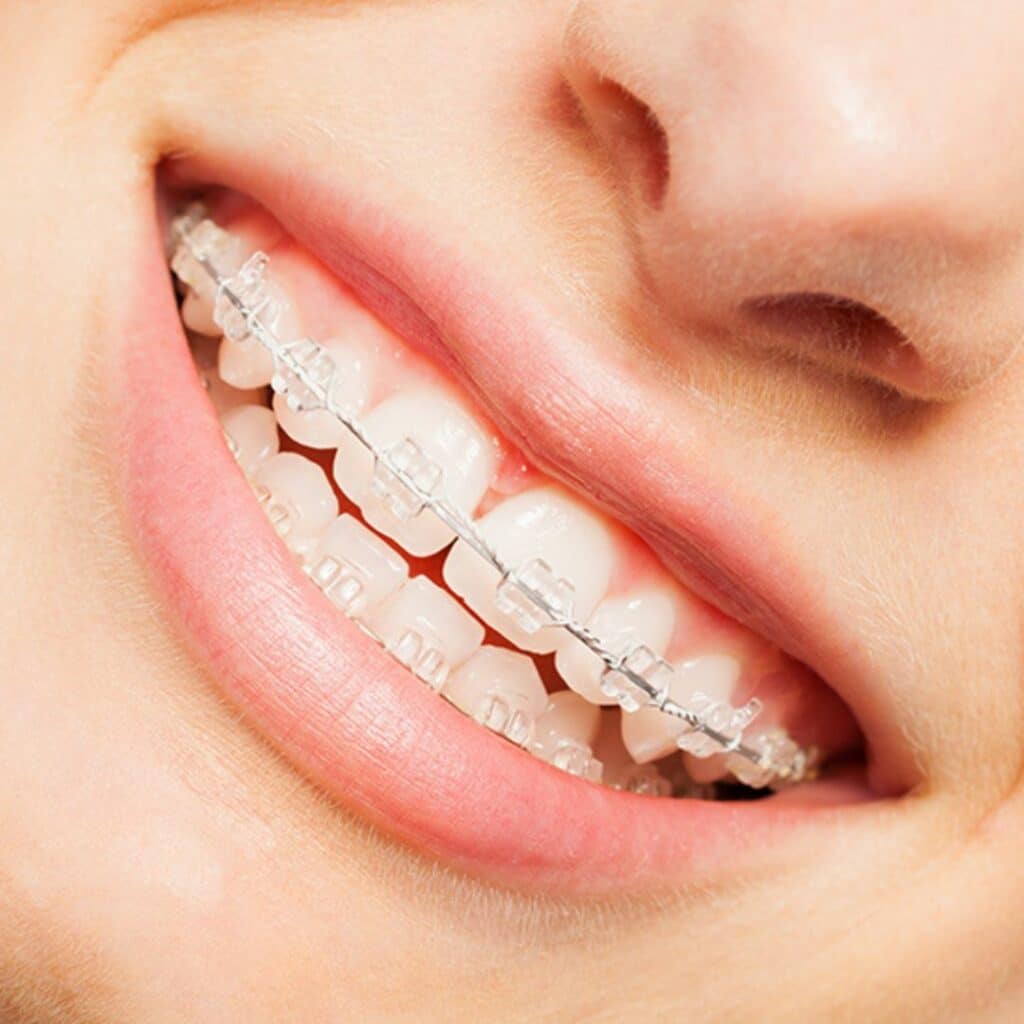 Clear braces at Happier Smiles Orthodontics in Escondido, CA