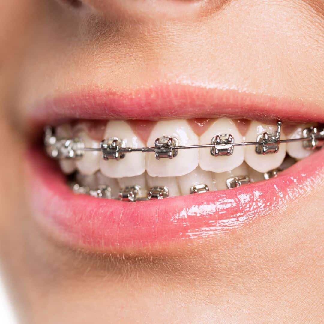 Braces Happier Smiles Orthodontics in Escondido, CA