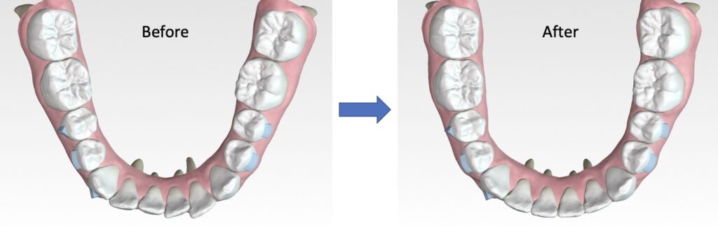 How Do Clear Aligners Work Orthodontist Escondido CA Invisalign 