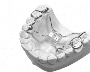Orthodontic Expander Happier Smiles Orthodontics