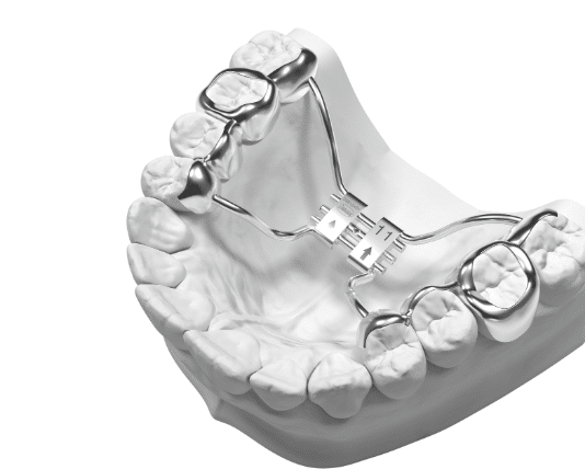 Orthodontic Expander Happier Smiles Orthodontics