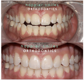 clear aligners happier smiles orthodontics escondido