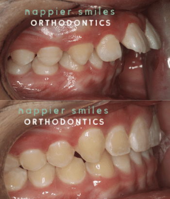 braces in escondido ca
